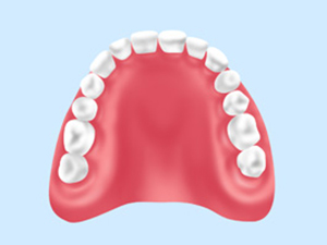 レジン義歯