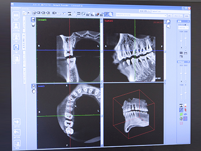 正確な診断のために～歯科用CTで3次元画像を作成～